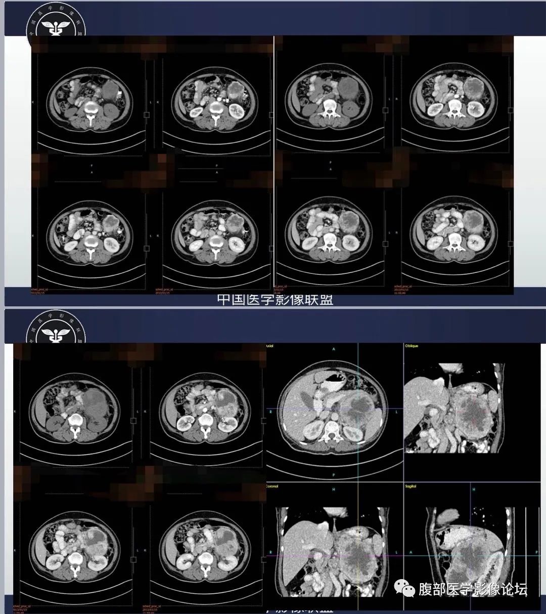 影像PPT - 【病例】腹膜后嗜铬细胞瘤1例CT影像-2 影像PPT - 【病例】腹膜后嗜铬细胞瘤1例CT影像-2
