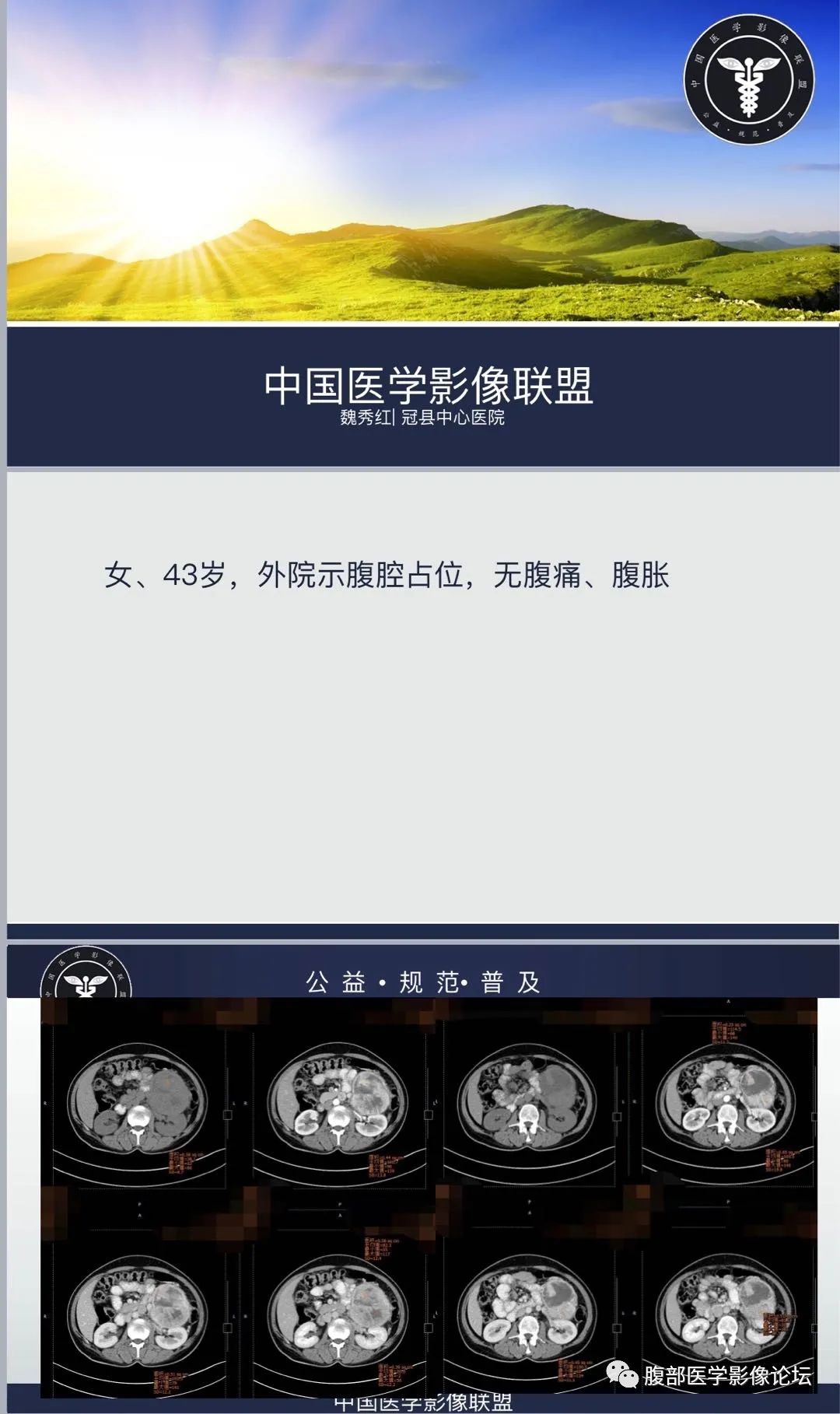 影像PPT - 【病例】腹膜后嗜铬细胞瘤1例CT影像-1 影像PPT - 【病例】腹膜后嗜铬细胞瘤1例CT影像-1