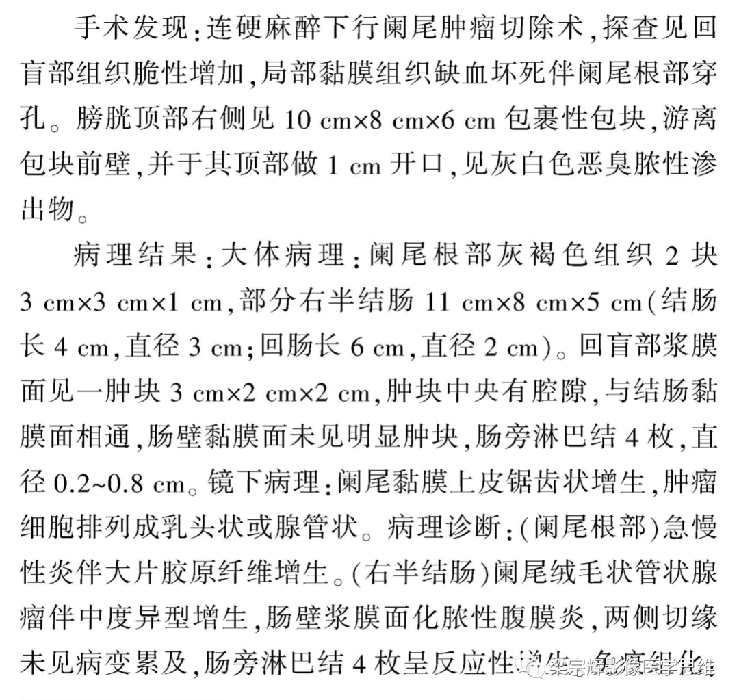 影像PPT - 【病例】阑尾良性肿瘤1例CT影像诊断思维-5