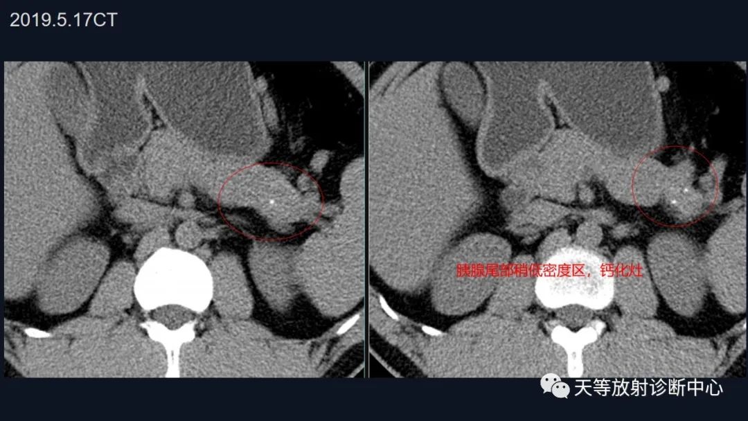 影像PPT - 【病例】胰腺神经内分泌肿瘤G2级1例CT及MR影像-1 影像PPT - 【病例】胰腺神经内分泌肿瘤G2级1例CT及MR影像-1