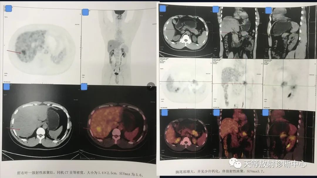 影像PPT - 【病例】胰腺神经内分泌肿瘤G2级1例CT及MR影像-17 影像PPT - 【病例】胰腺神经内分泌肿瘤G2级1例CT及MR影像-17