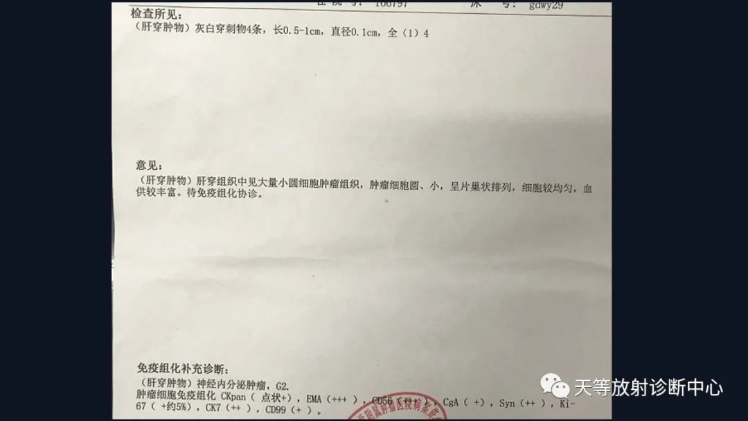 影像PPT - 【病例】胰腺神经内分泌肿瘤G2级1例CT及MR影像-18 影像PPT - 【病例】胰腺神经内分泌肿瘤G2级1例CT及MR影像-18