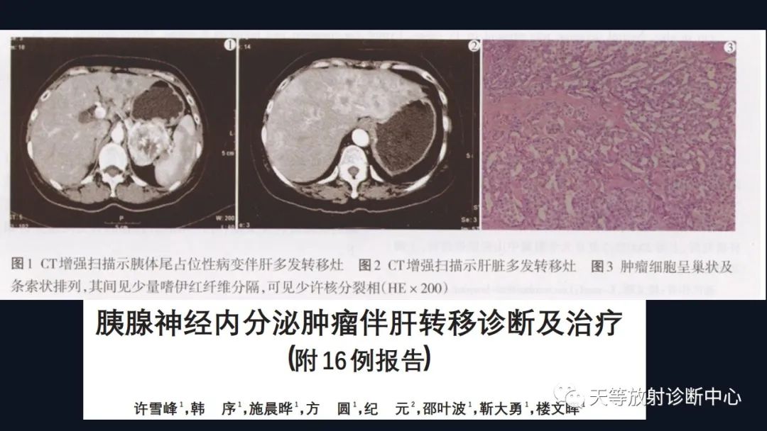 影像PPT - 【病例】胰腺神经内分泌肿瘤G2级1例CT及MR影像-22 影像PPT - 【病例】胰腺神经内分泌肿瘤G2级1例CT及MR影像-22