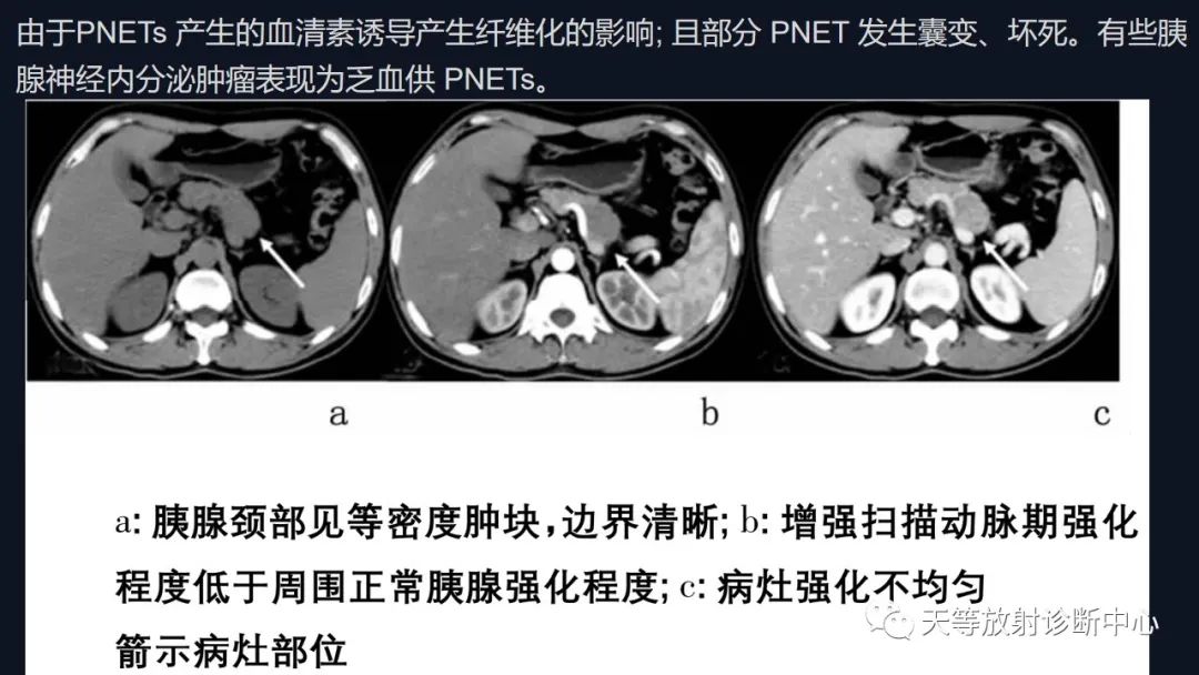 影像PPT - 【病例】胰腺神经内分泌肿瘤G2级1例CT及MR影像-23 影像PPT - 【病例】胰腺神经内分泌肿瘤G2级1例CT及MR影像-23