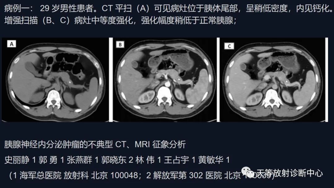 影像PPT - 【病例】胰腺神经内分泌肿瘤G2级1例CT及MR影像-24 影像PPT - 【病例】胰腺神经内分泌肿瘤G2级1例CT及MR影像-24