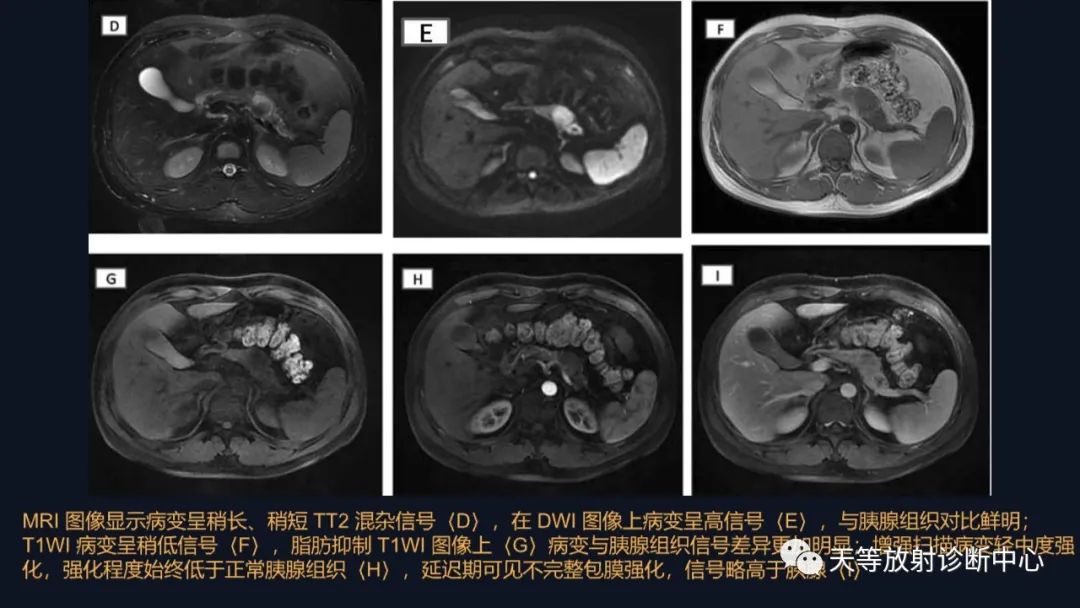 影像PPT - 【病例】胰腺神经内分泌肿瘤G2级1例CT及MR影像-25 影像PPT - 【病例】胰腺神经内分泌肿瘤G2级1例CT及MR影像-25