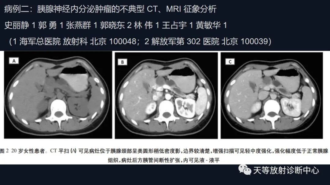 影像PPT - 【病例】胰腺神经内分泌肿瘤G2级1例CT及MR影像-26 影像PPT - 【病例】胰腺神经内分泌肿瘤G2级1例CT及MR影像-26