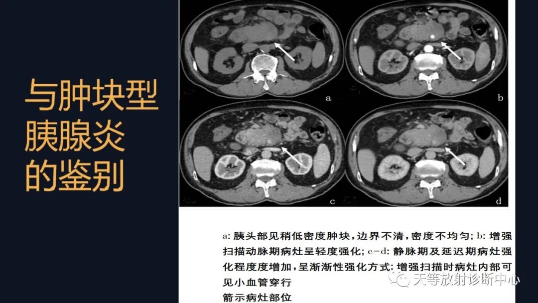 影像PPT - 【病例】胰腺神经内分泌肿瘤G2级1例CT及MR影像-27 影像PPT - 【病例】胰腺神经内分泌肿瘤G2级1例CT及MR影像-27