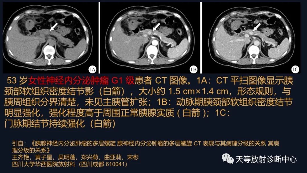影像PPT - 【病例】胰腺神经内分泌肿瘤G2级1例CT及MR影像-28 影像PPT - 【病例】胰腺神经内分泌肿瘤G2级1例CT及MR影像-28