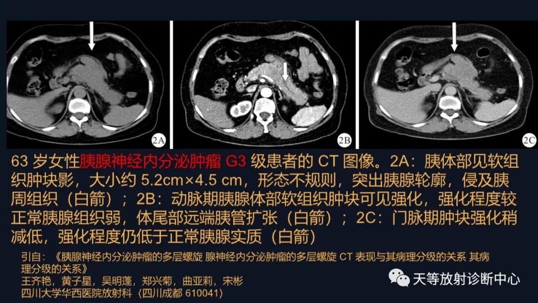 影像PPT - 【病例】胰腺神经内分泌肿瘤G2级1例CT及MR影像-29 影像PPT - 【病例】胰腺神经内分泌肿瘤G2级1例CT及MR影像-29
