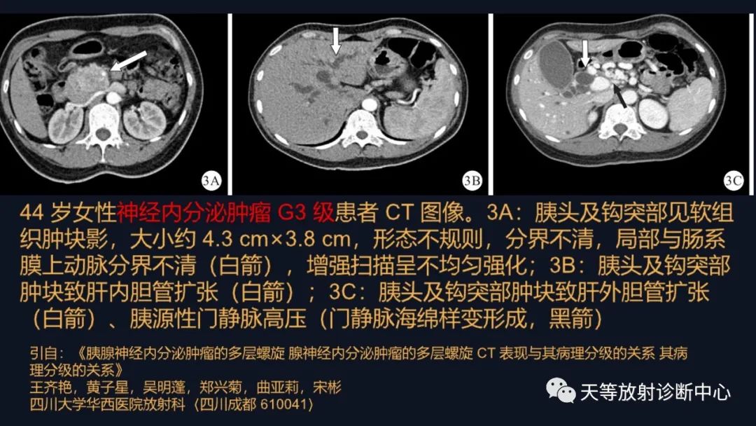 影像PPT - 【病例】胰腺神经内分泌肿瘤G2级1例CT及MR影像-30 影像PPT - 【病例】胰腺神经内分泌肿瘤G2级1例CT及MR影像-30