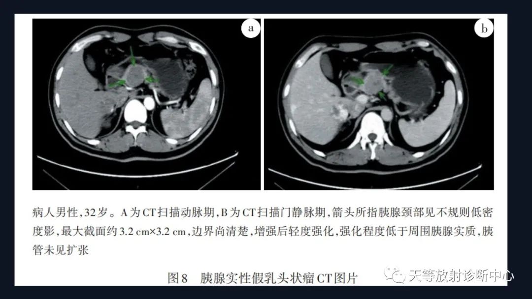 影像PPT - 【病例】胰腺神经内分泌肿瘤G2级1例CT及MR影像-31 影像PPT - 【病例】胰腺神经内分泌肿瘤G2级1例CT及MR影像-31