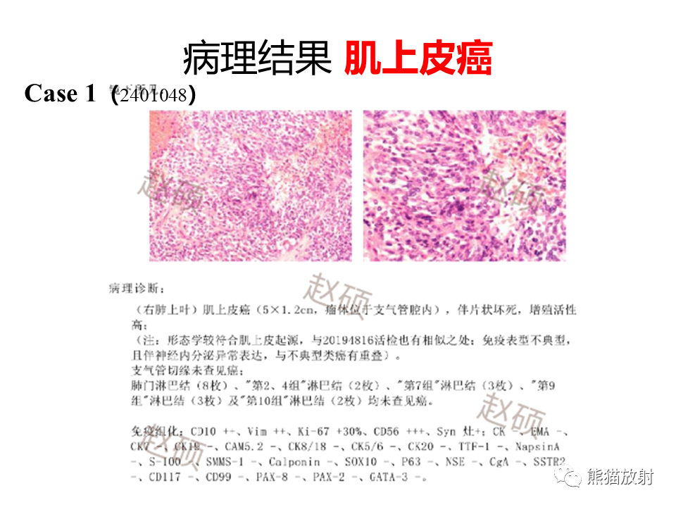 影像PPT - 【病例】肺肌上皮癌 VS 鳞状细胞癌CT影像-21