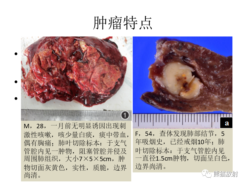 影像PPT - 【病例】肺肌上皮癌 VS 鳞状细胞癌CT影像-25