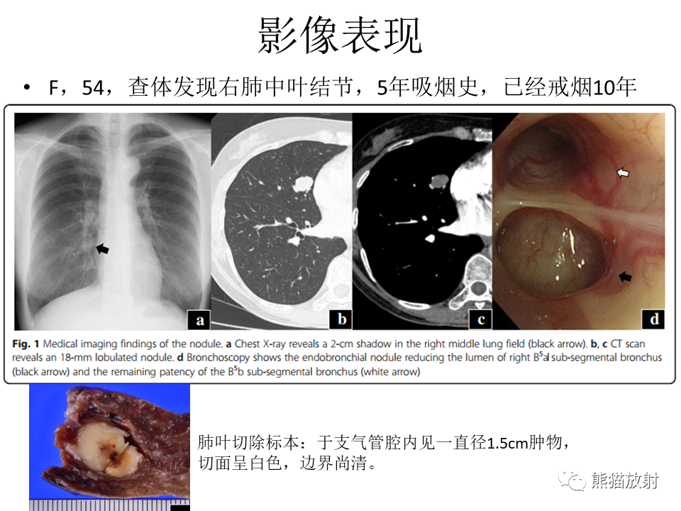 影像PPT - 【病例】肺肌上皮癌 VS 鳞状细胞癌CT影像-26