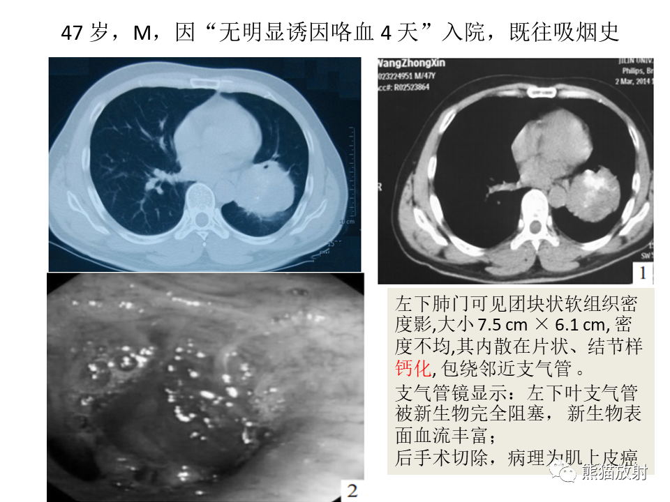 影像PPT - 【病例】肺肌上皮癌 VS 鳞状细胞癌CT影像-27
