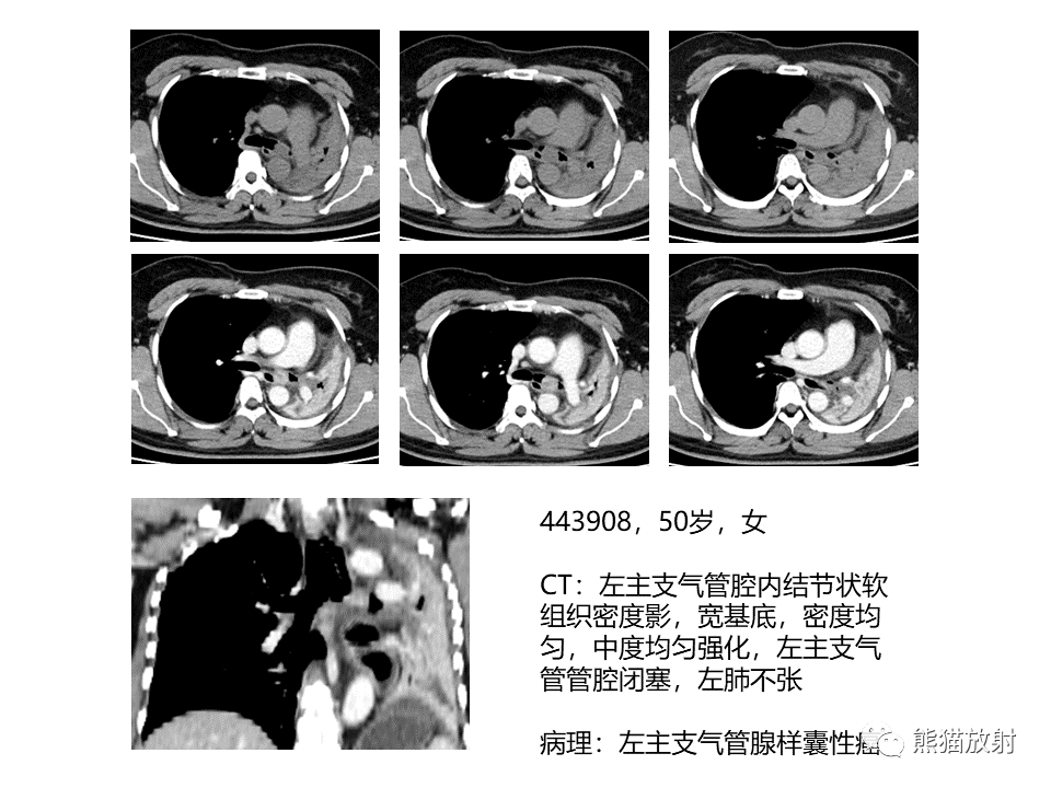 影像PPT - 【病例】肺肌上皮癌 VS 鳞状细胞癌CT影像-34