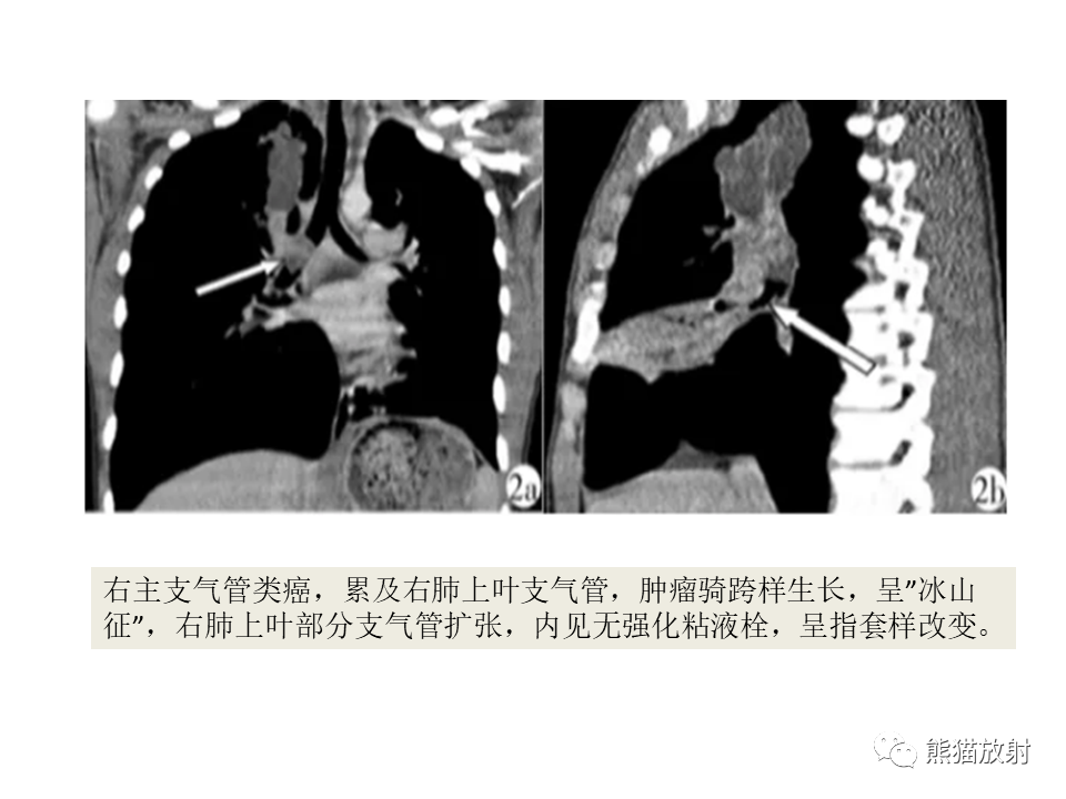 影像PPT - 【病例】肺肌上皮癌 VS 鳞状细胞癌CT影像-36