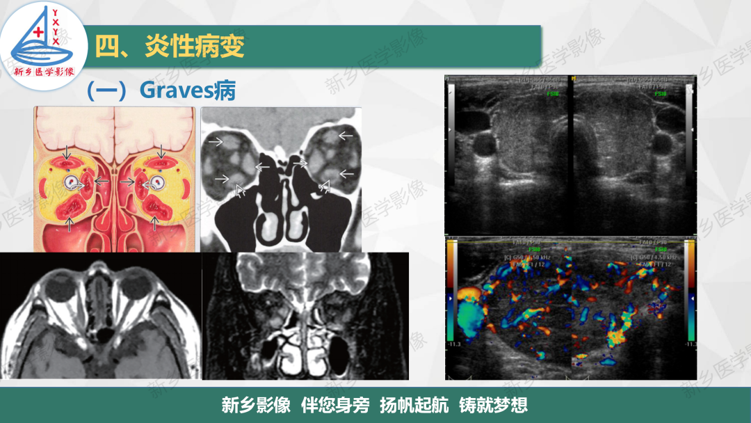 影像PPT - 【PPT】医学影像诊断学教材解读—颈部疾病-4