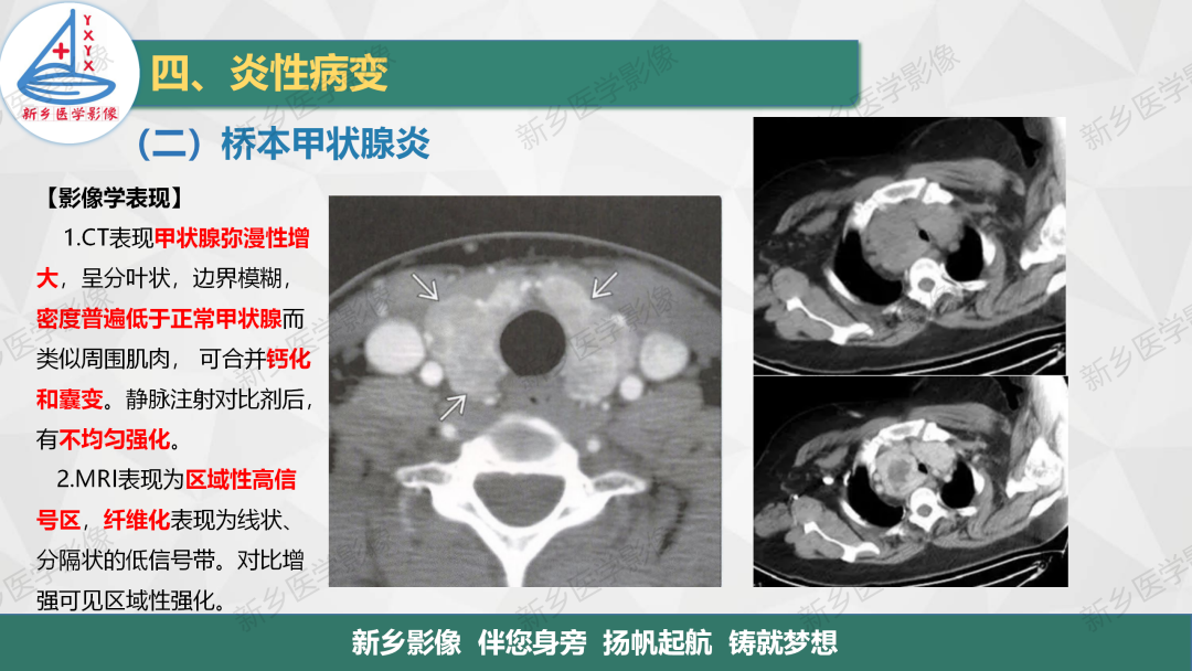 影像PPT - 【PPT】医学影像诊断学教材解读—颈部疾病-6