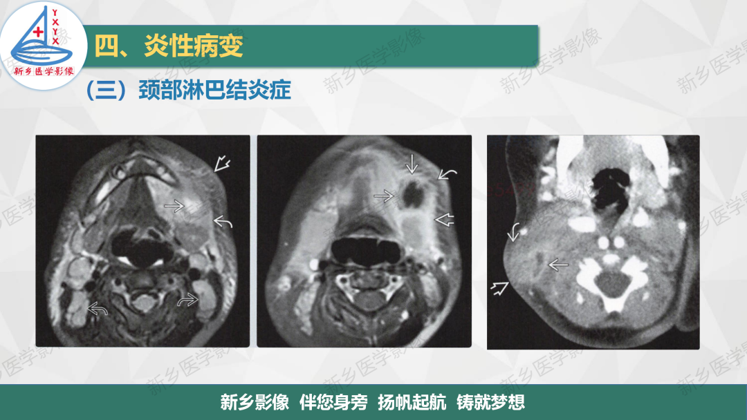 影像PPT - 【PPT】医学影像诊断学教材解读—颈部疾病-8