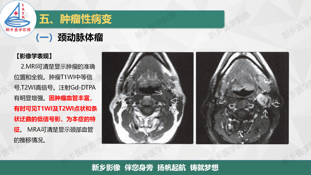 影像PPT - 【PPT】医学影像诊断学教材解读—颈部疾病-12