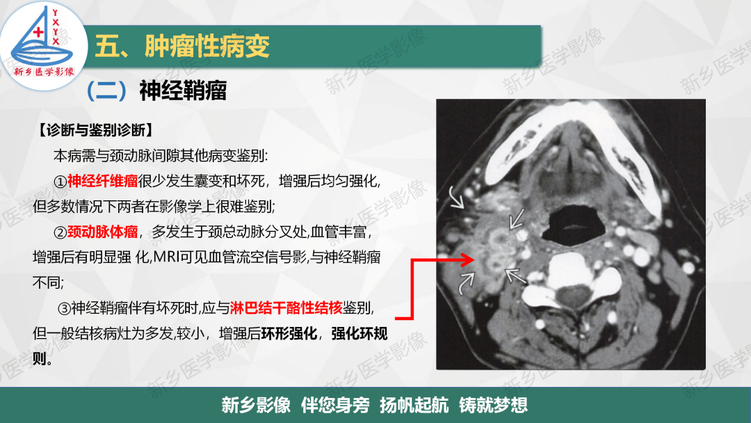 影像PPT - 【PPT】医学影像诊断学教材解读—颈部疾病-16