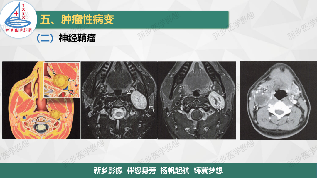 影像PPT - 【PPT】医学影像诊断学教材解读—颈部疾病-15