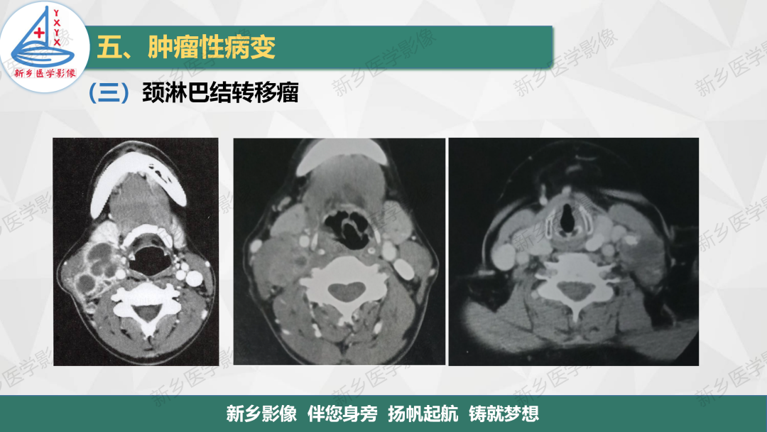 影像PPT - 【PPT】医学影像诊断学教材解读—颈部疾病-19