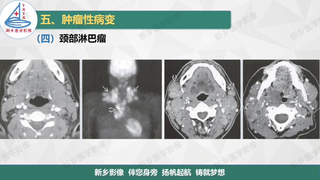 影像PPT - 【PPT】医学影像诊断学教材解读—颈部疾病-21