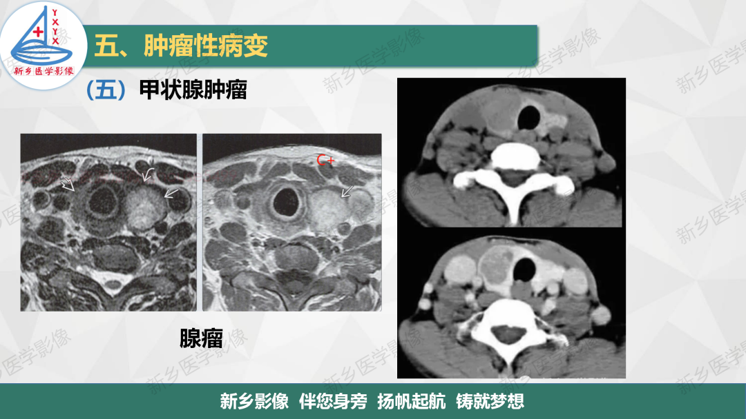 影像PPT - 【PPT】医学影像诊断学教材解读—颈部疾病-24