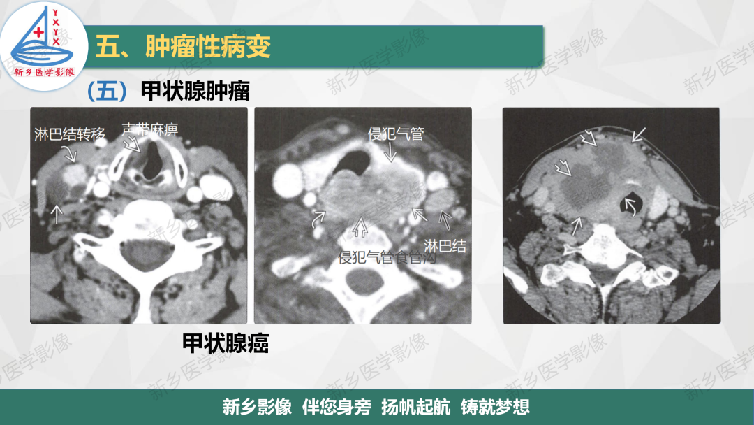 影像PPT - 【PPT】医学影像诊断学教材解读—颈部疾病-25