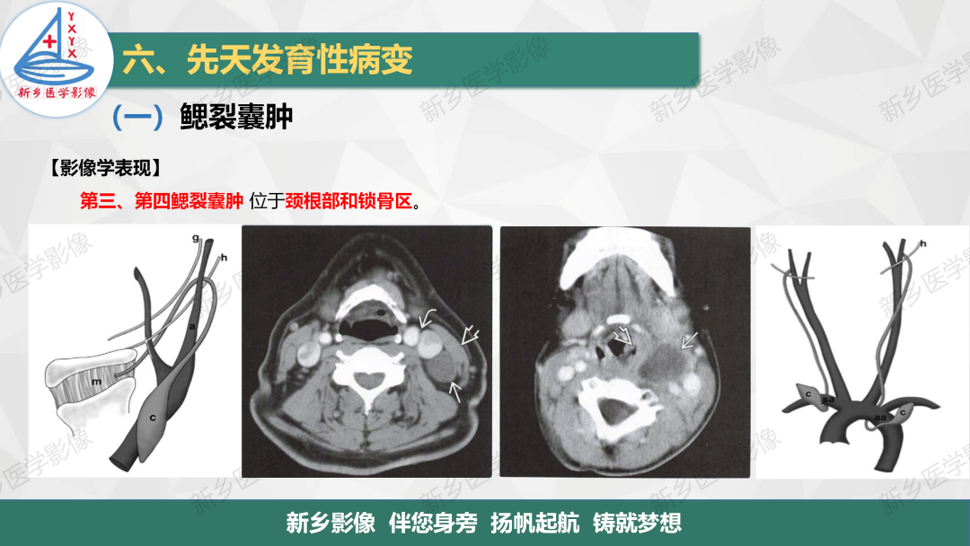 影像PPT - 【PPT】医学影像诊断学教材解读—颈部疾病-30