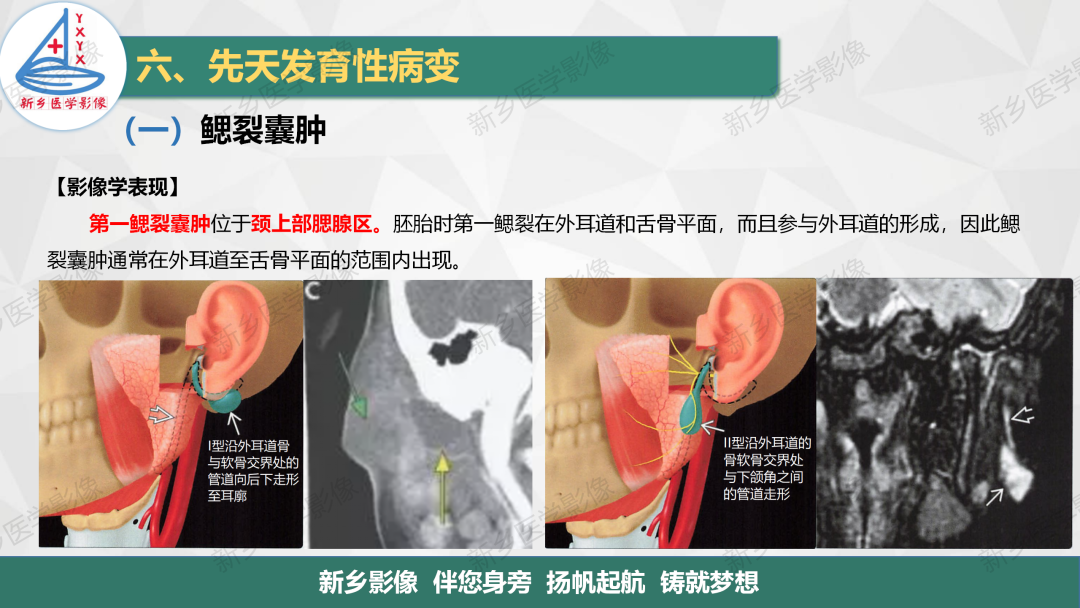 影像PPT - 【PPT】医学影像诊断学教材解读—颈部疾病-28