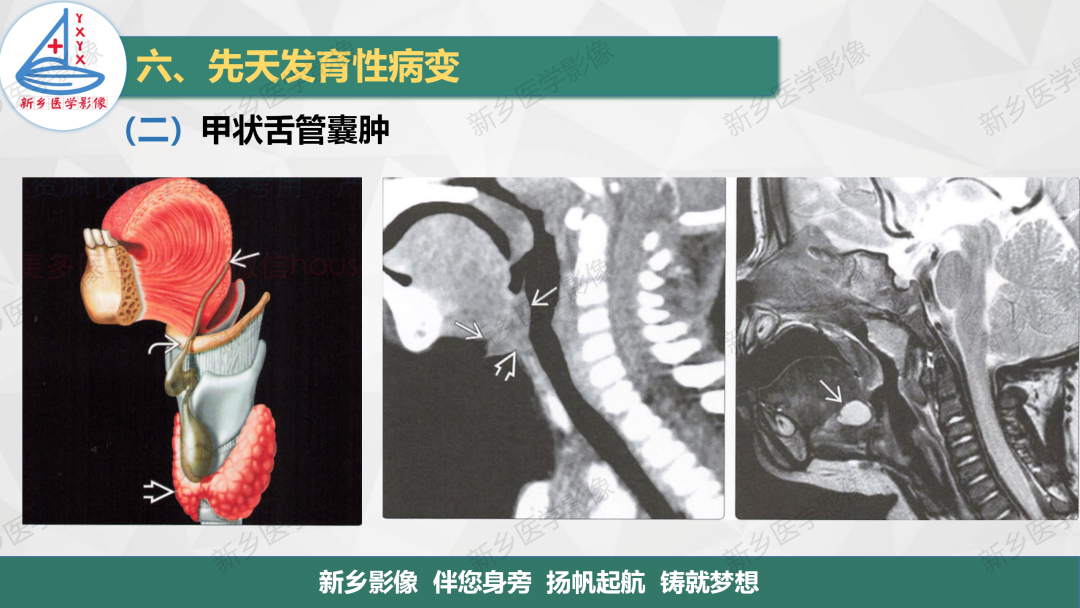 影像PPT - 【PPT】医学影像诊断学教材解读—颈部疾病-33