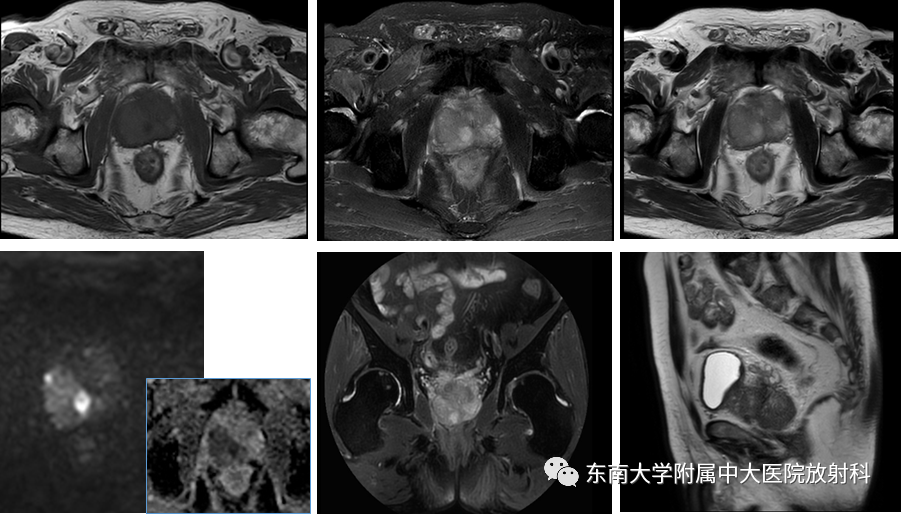影像PPT - 【病例】前列腺病例随访讨论3例MR-3 影像PPT - 【病例】前列腺病例随访讨论3例MR-3