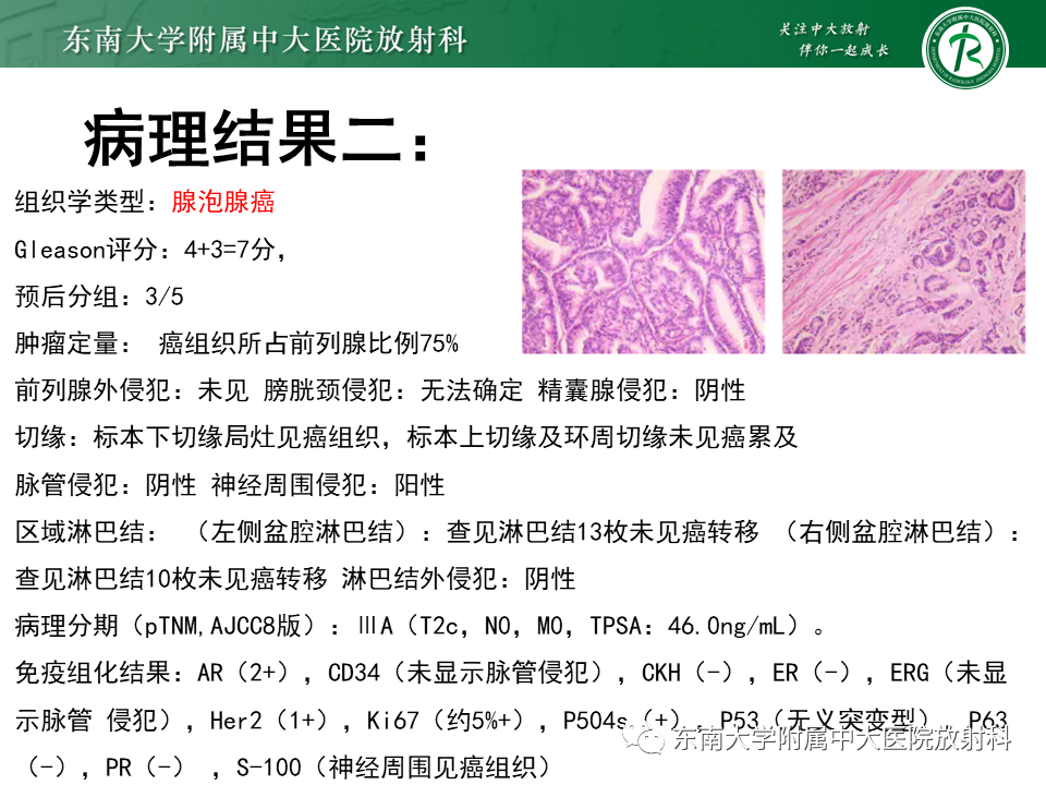 影像PPT - 【病例】前列腺病例随访讨论3例MR-6 影像PPT - 【病例】前列腺病例随访讨论3例MR-6