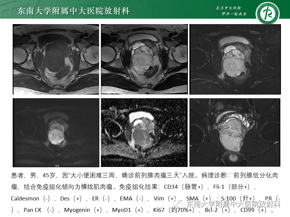 影像PPT - 【病例】前列腺病例随访讨论3例MR-14 影像PPT - 【病例】前列腺病例随访讨论3例MR-14