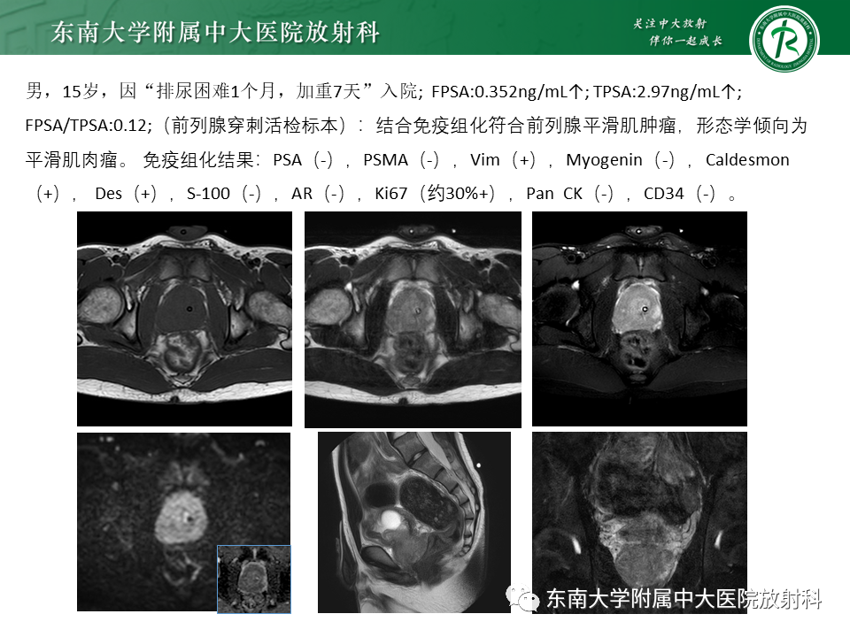 影像PPT - 【病例】前列腺病例随访讨论3例MR-15 影像PPT - 【病例】前列腺病例随访讨论3例MR-15