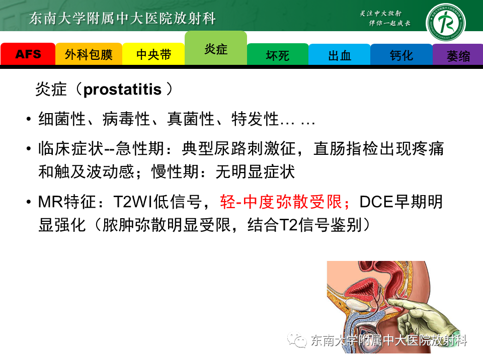 影像PPT - 【病例】前列腺病例随访讨论3例MR-21 影像PPT - 【病例】前列腺病例随访讨论3例MR-21