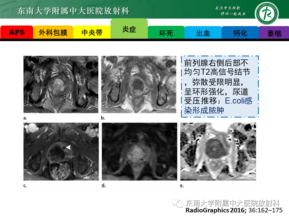 影像PPT - 【病例】前列腺病例随访讨论3例MR-22 影像PPT - 【病例】前列腺病例随访讨论3例MR-22