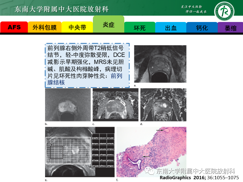 影像PPT - 【病例】前列腺病例随访讨论3例MR-24 影像PPT - 【病例】前列腺病例随访讨论3例MR-24