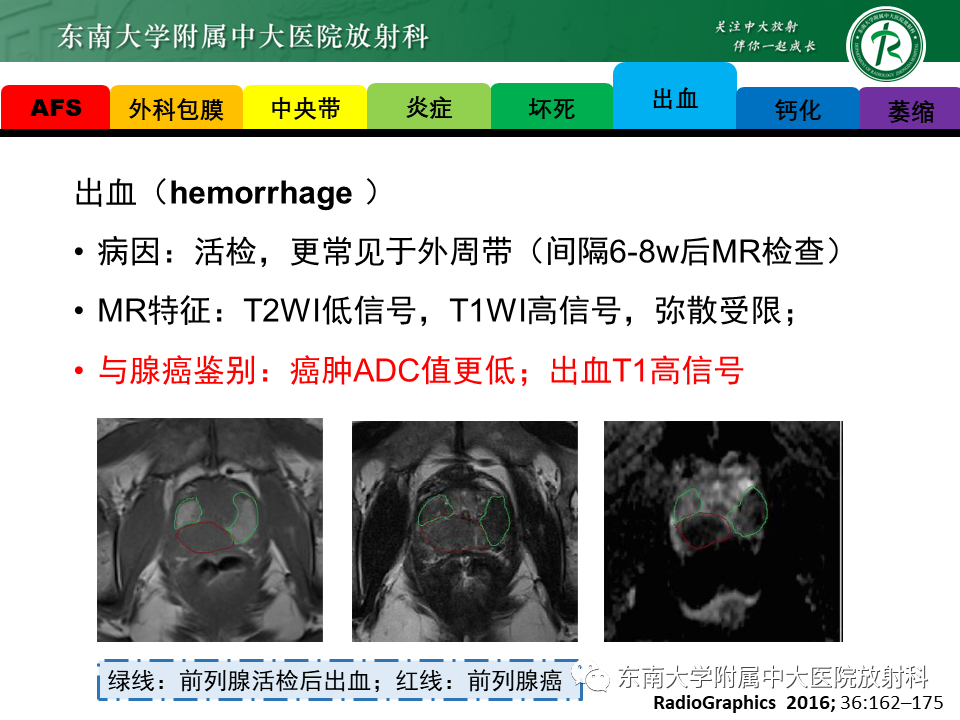 影像PPT - 【病例】前列腺病例随访讨论3例MR-26 影像PPT - 【病例】前列腺病例随访讨论3例MR-26