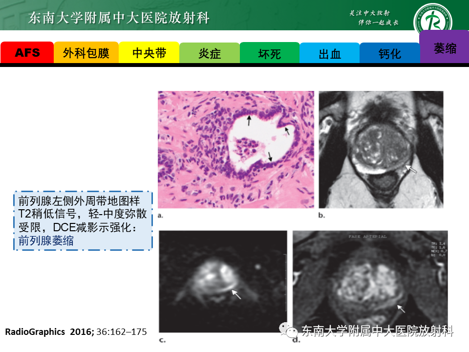 影像PPT - 【病例】前列腺病例随访讨论3例MR-29 影像PPT - 【病例】前列腺病例随访讨论3例MR-29