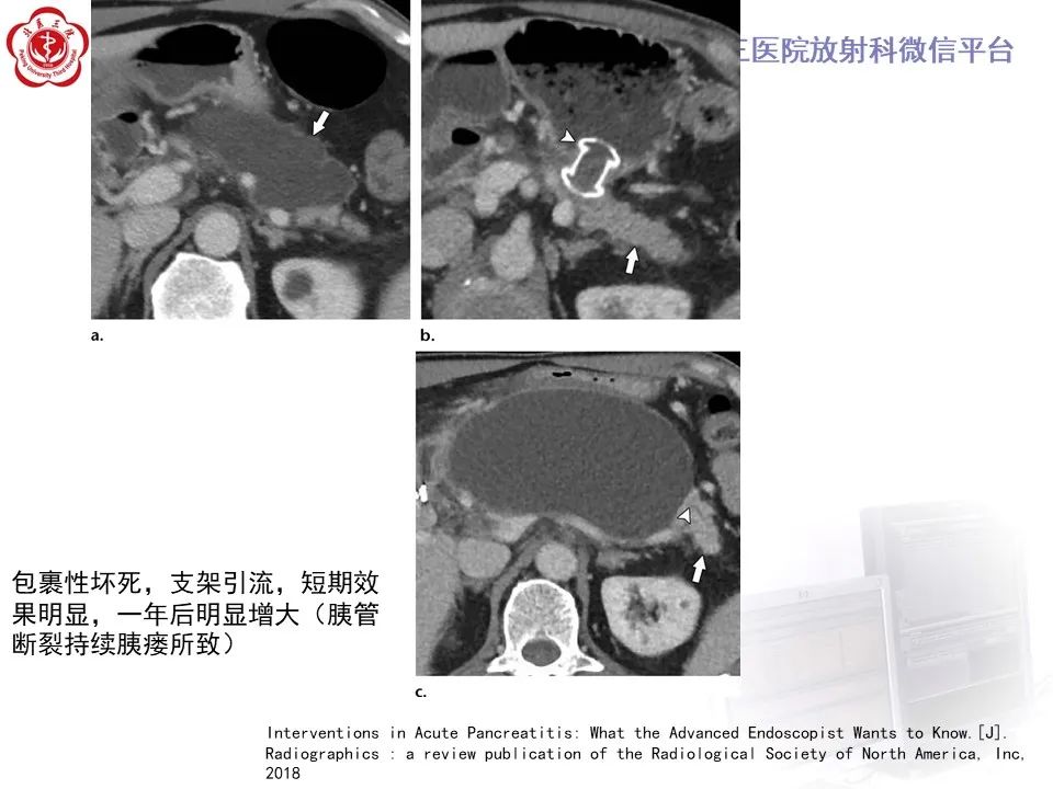 影像PPT - 【PPT】基于急性胰腺炎诊疗指南的影像诊断注意事项-37