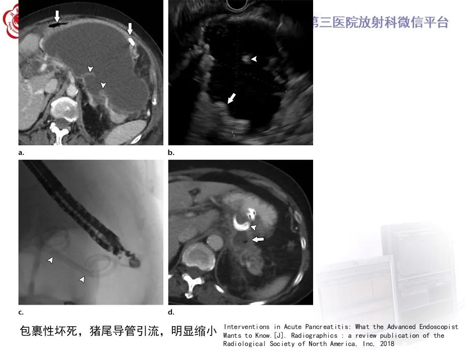 影像PPT - 【PPT】基于急性胰腺炎诊疗指南的影像诊断注意事项-36