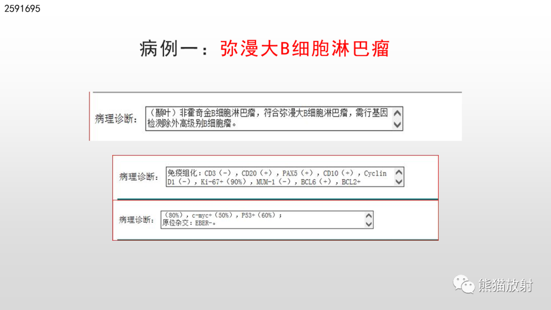 影像PPT - 【PPT】脑淋巴瘤 VS 胶质母细胞瘤-24