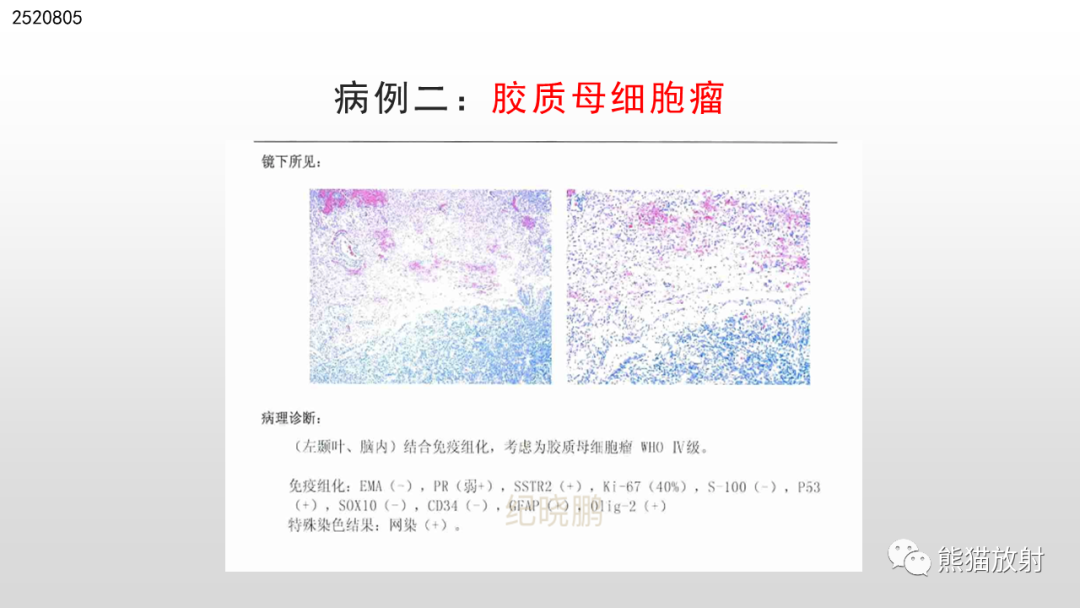 影像PPT - 【PPT】脑淋巴瘤 VS 胶质母细胞瘤-25
