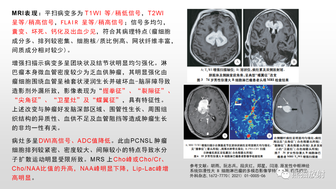 影像PPT - 【PPT】脑淋巴瘤 VS 胶质母细胞瘤-29