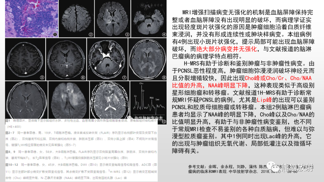 影像PPT - 【PPT】脑淋巴瘤 VS 胶质母细胞瘤-32